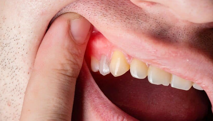 Viêm nướu răng do bệnh tiểu đường